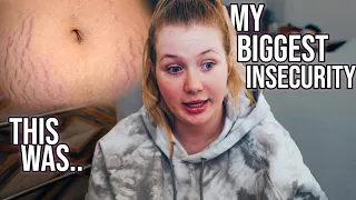 My Laser Stretch Mark Removal Horror Story | Vlogmas 3