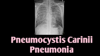 Pneumocystis Carinii Pneumonia || PCP || Pneumocystis Jirovecii