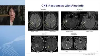 Segment 2: Molecular Targets in NSCLC