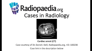 Cardiac arrest [CT] (Radiopaedia.org) Cases in Radiology