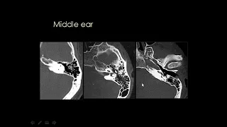 Dr Mamdouh Mahfouz Head and neck imaging Petrous bone Anatomy