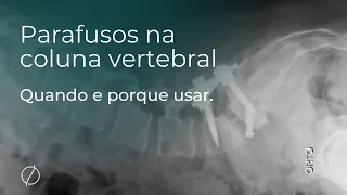 Parafusos na coluna: Quando e em quais casos é necessário implantá-los? #cirurgiaodecoluna