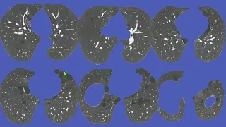 Cystic Lung Disease