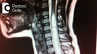 How to manage Syringomyelia in 45 year old? - Dr. Mohan M R
