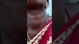 Thyroid Gland swelling moving on swallowing(Deglutition)