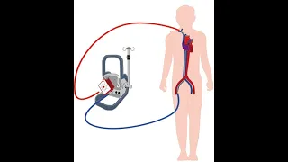 ECMO Complications and Troubleshooting_Dr Pradeep Rangappa