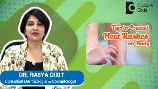 Cure for Heat Rashes / Sweat Rashes - By Dr. Rasya Dixit | Doctors' Circle