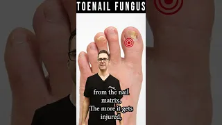 How to Know If Toenail Fungus is Dying? [How Fast Do Nails Grow?]