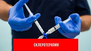 Все о склеротерапии