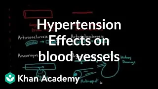 Hypertension effects on the blood vessels | Health & Medicine | Khan Academy