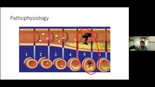 AHD 4 22 21 ACS and Myocardial Injury J Hourmozdi