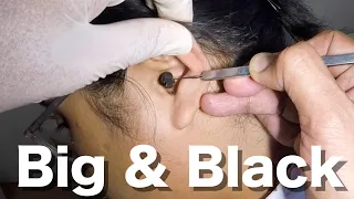 Big Black Earwax STUCK in Young Woman's Ear Removed