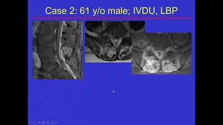 Imaging Spine infection