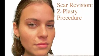 Scar Revision: Z-Plasty Procedure