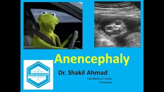 Anencephaly #ultrasound #anomolyscan