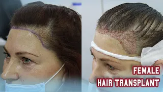 Female Hair Transplant Surgery in Turkey | Estenbul Health