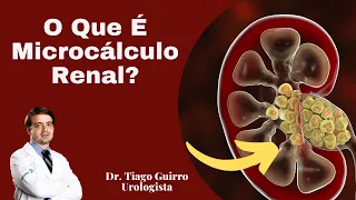 Areia no Rim! Saiba tudo sobre o Microcalculo renal!