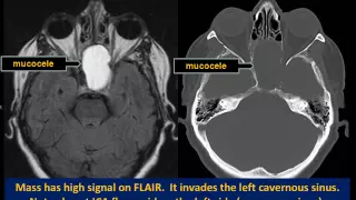 Sphenoid Sinus: Mucous Retention Cyst vs. Mucocele