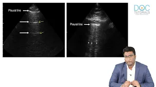 LUNG Ultrasound