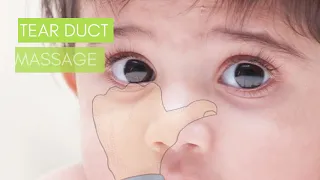 How to Massage Blocked Tear Duct in Children