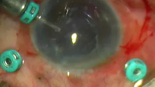 RETINA: Sight Back to Forgotten Eye - Post-Uveitis