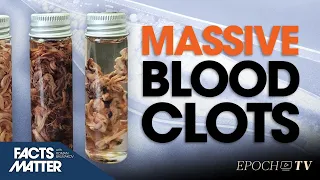 How Spike Proteins Cause Massive ‘Twisted’ Blood Clots, as Well as 200 Related Symptoms | Trailer