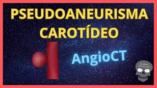 PSEUDOANEURISMA CAROTÍDEO 👉Así se ve en ANGIOTOMOGRAFÍA