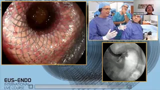 EUS guidance or ERCP for biliary drainage? - Prof. Marc GIOVANNINI