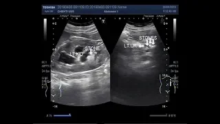 Ultrasound Video showing a large renal stone with multiple ureteric stones.