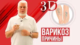 Варикоз, причины