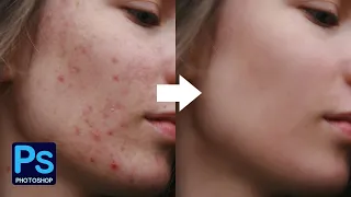 피부보정 여드름 및 흉터제거 방법 주파수 분리기법 포토샵강좌 How to remove acne and scars Photoshop Lecture