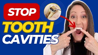 How to Prevent and Reverse Tooth Cavities & Dental Disease + FREE Natural Cavity Remedy Download