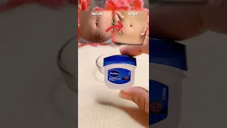 Stretch Marks Removal Cream at Home 💯 #viral #stretchmarks #skincare #stretchmarkscream #shorts