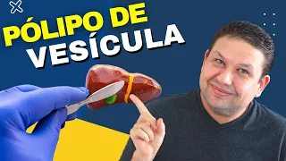 PÓLIPO DE VESÍCULA BILIAR? SAIBA COMO TRATAR O PÓLIPO DA VESÍCULA? O que é pólipo de vesícula.