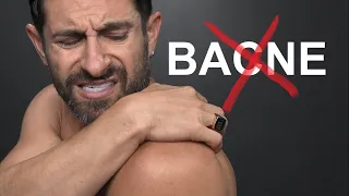 How To ELIMINATE Back Acne!