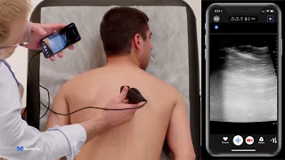 Ultrasound Education: Performing an Erector Spinae Plane Block