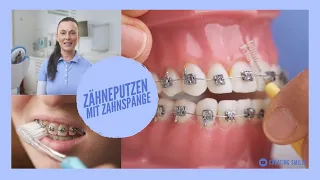 Zähneputzen mit Brackets - Unsere Tipps um die Zahnspange richtig sauber zu bekommen