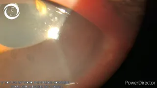 Corneal perforation with aqueous fountain