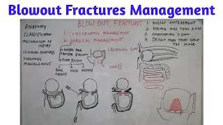 Blowout fractures management