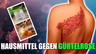 10 Natürliche Hausmittel gegen Gürtelrose