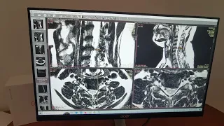 Резорбция большой грыжи в шее C5-C6