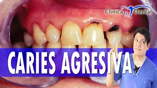 ¡ Caries Agresiva ! Información Clínica Dental Dr Velez CDMX