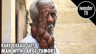 Rare Disease left Man With Large Tumors And Melting Face