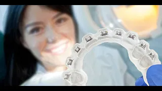 Braces Transformation with Custom Braces: Faster, Less Pain, Same Cost