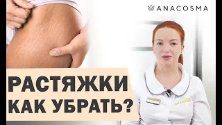 ❗️Как убрать растяжки и стрии?❗️❗️ 👍ТОП-процедур👍