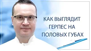 Как выглядит герпес на половых губах