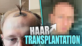 Meine Haartransplantion in der Türkei! Mit Liveaufnahmen aus dem Op-Saal! @Elithair