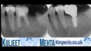 Lower Molar Extraction & Immediate AnyRidge Implant Placement.