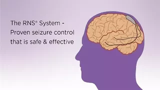 Treating seizures at their source: Neurostimulation device monitors brain activity, reduces seizures