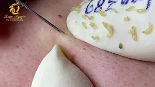 Pimple popping and blackheads extraction (389) | Loan Nguyen